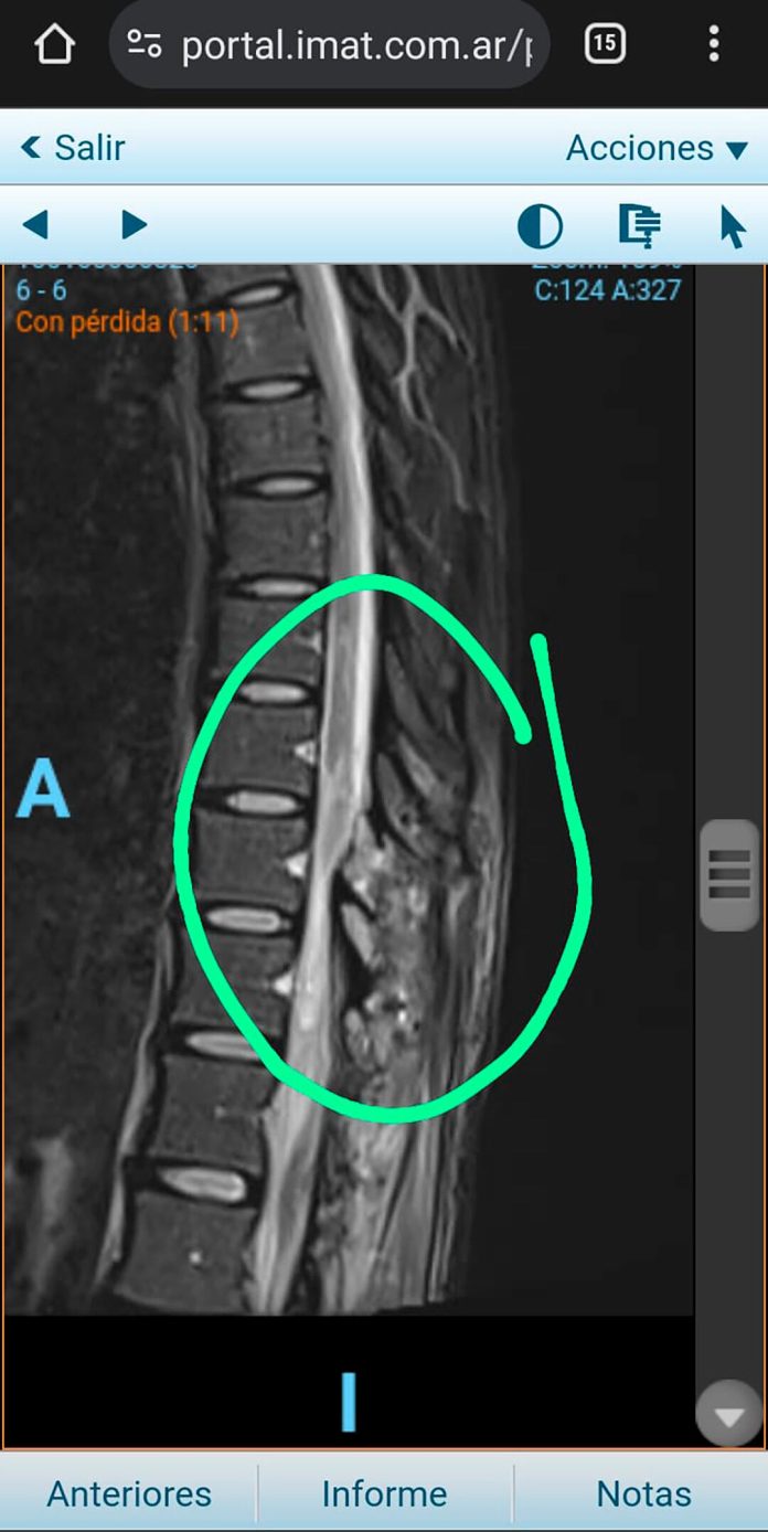 El drama de una chica que se operó para mejorar un calambre y ahora no puede caminar: denuncia mala praxis