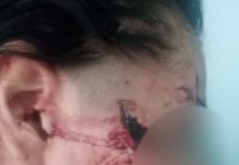 Cómo evoluciona la chica de 15 años acuchillada en el rostro por una patota en Santa Fe