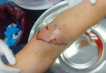 “Me veía hasta el hueso”: una mujer denunció que dos perros la atacaron y le provocaron heridas graves