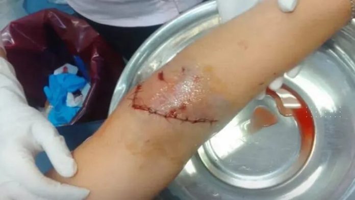 “Me veía hasta el hueso”: una mujer denunció que dos perros la atacaron y le provocaron heridas graves